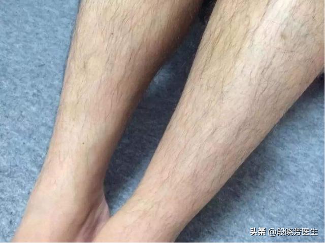 多毛糖尿病(多糖糖尿病病人能吃吗)
