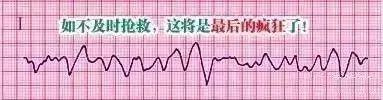 一分钟快速看懂心电图，1分钟教你看懂心电图