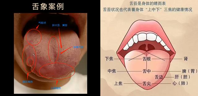 舌头有齿痕说明脾虚很严重吗，舌诊分析舌头肥厚