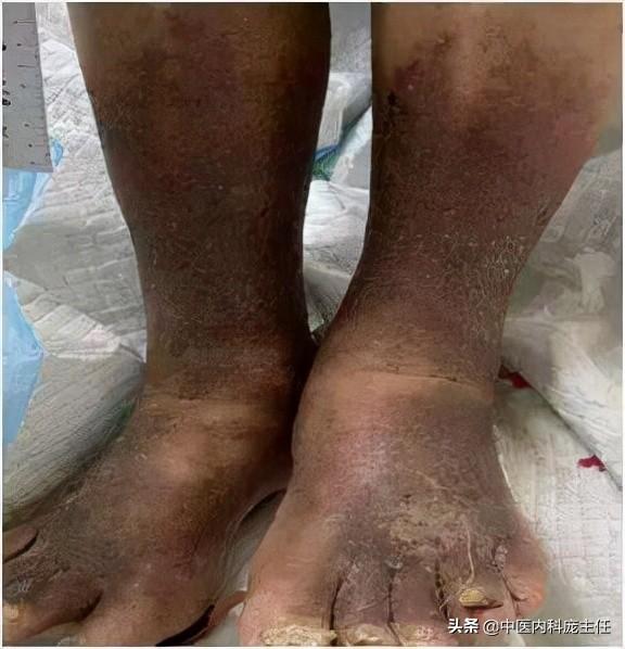 糖尿病脚木(糖尿病脚麻木吃什么药)