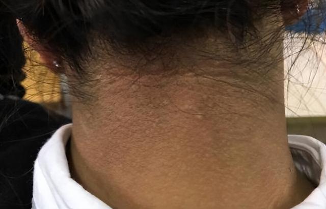 肥胖型黑棘皮症外用药(肥胖型黑棘皮症的疣状赘生物传染吗)