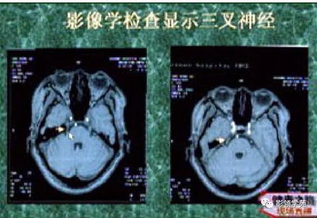 面部血管分布图，三叉神经分支及面部分布规律（玻尿酸怎么打，才会避免栓塞呢）