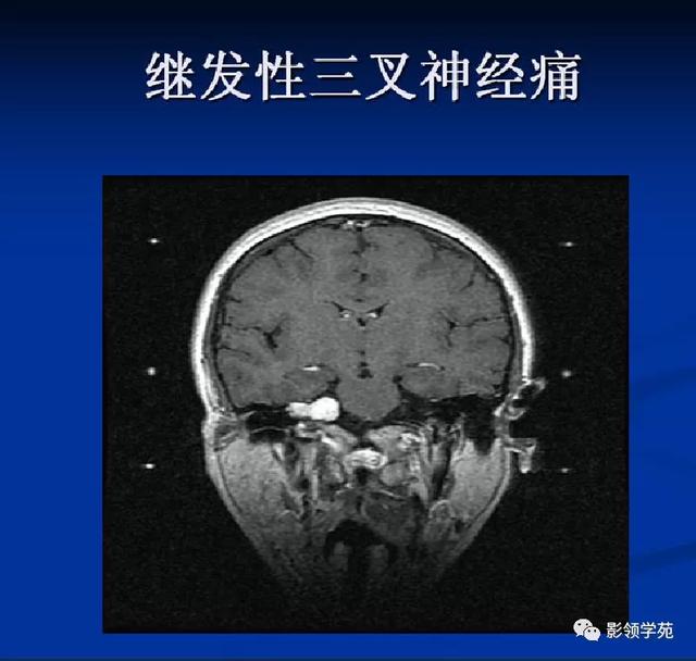 面部血管分布图，三叉神经分支及面部分布规律（玻尿酸怎么打，才会避免栓塞呢）