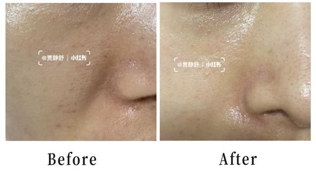 缩毛孔最有效方法，收缩毛孔最好的方法
