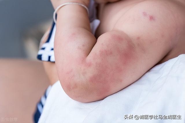 消风散治湿疹的效果，湿疹、荨麻疹、神经性皮炎、皮癣、皮肤瘙痒皆可用