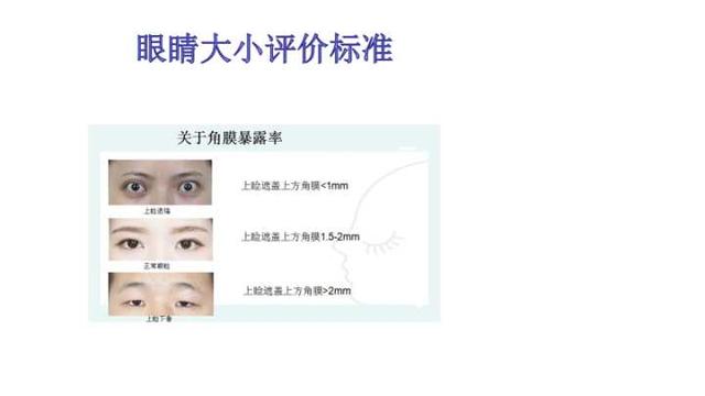大小眼自我矫正方法，大小眼矫正方法（如何矫正大小眼）