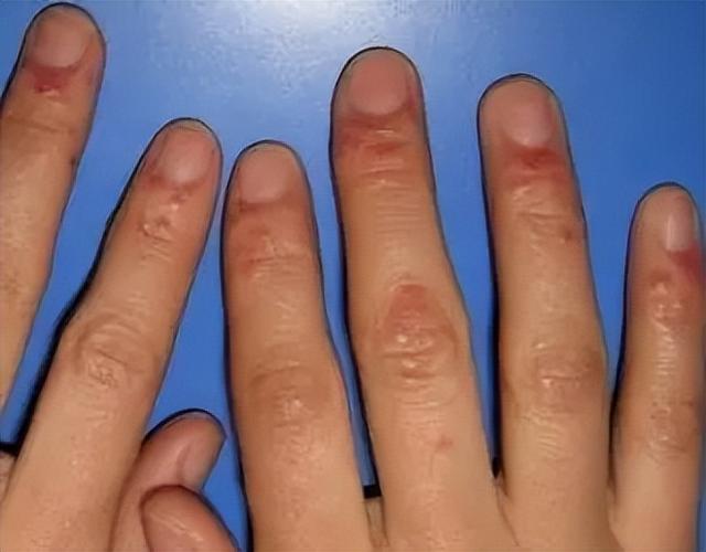 得了湿疹不要怕湿疹也有克星，这3个治疗方法或能派上大用场