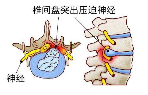 肩颈酸痛的厉害是什么原因，五大原因六大方法来缓解