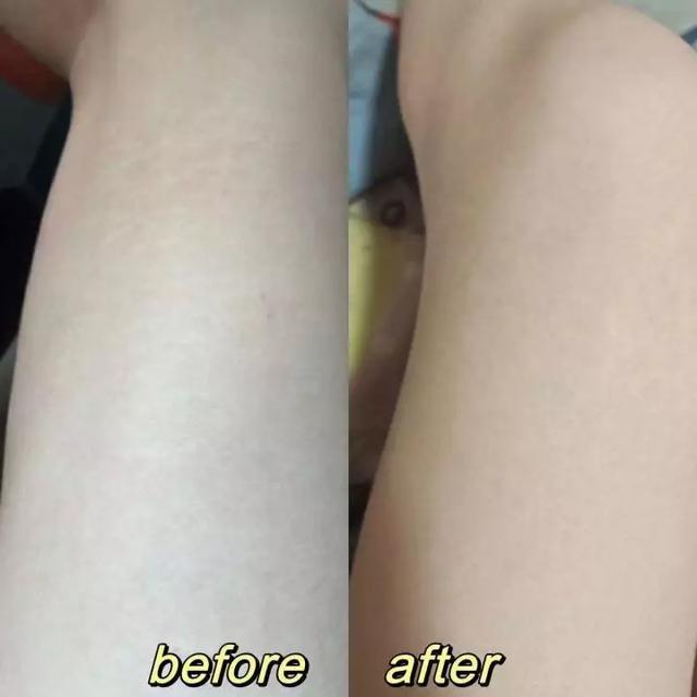 淡纹印液可以去肥胖纹吗(淡纹印液可以去妊娠纹吗)