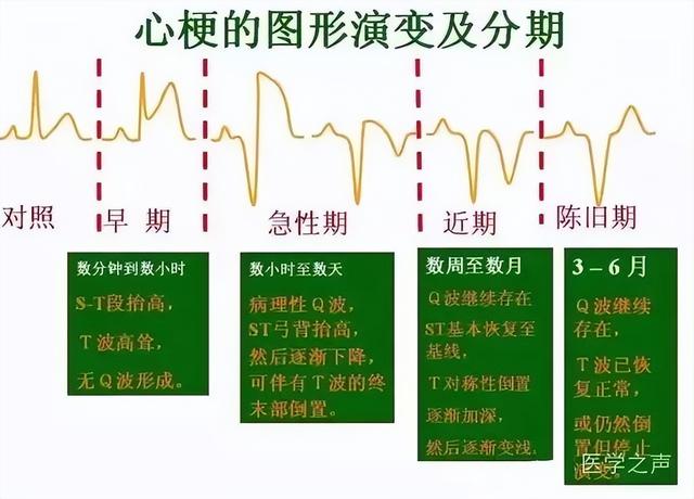 一分钟快速看懂心电图，1分钟教你看懂心电图