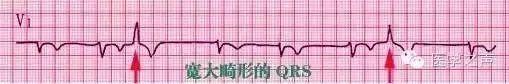 一分钟快速看懂心电图，1分钟教你看懂心电图