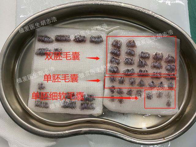 一图解析植发手术全流程，揭秘植发手术的全过程