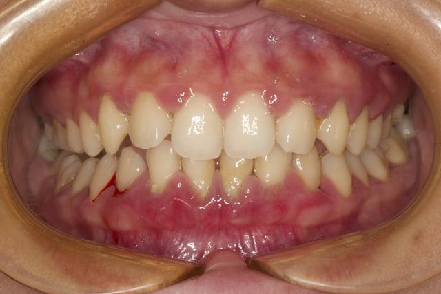 第一次洗牙疼不疼，洗牙疼不疼大概多长时间（分享一下第一次洗牙的经历和感受）