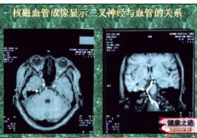 面部血管分布图，三叉神经分支及面部分布规律（玻尿酸怎么打，才会避免栓塞呢）