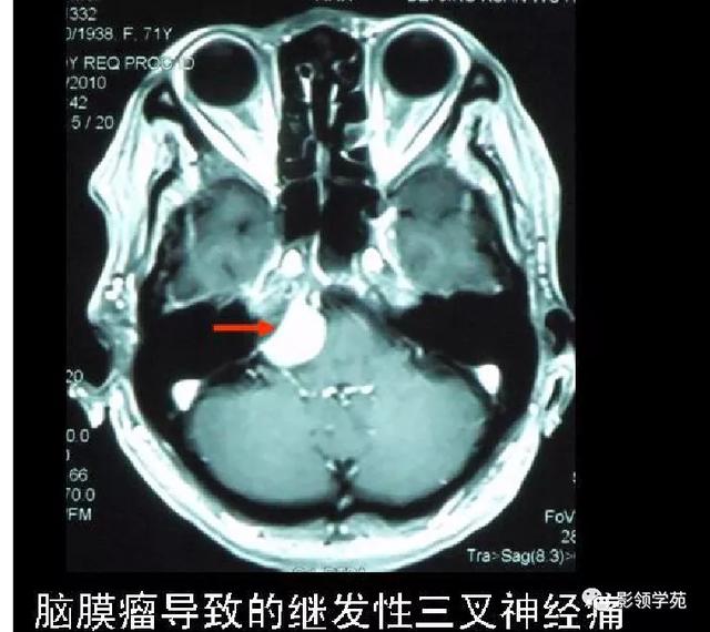 面部血管分布图，三叉神经分支及面部分布规律（玻尿酸怎么打，才会避免栓塞呢）