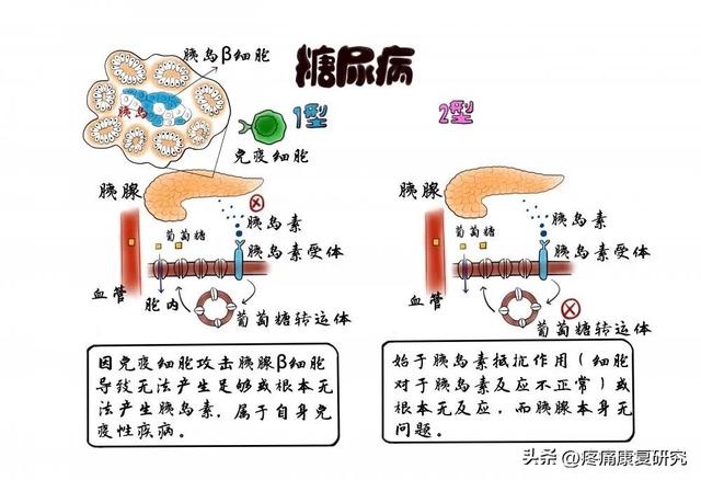 糖尿病软骨(糖尿病患者软肋骨疼)