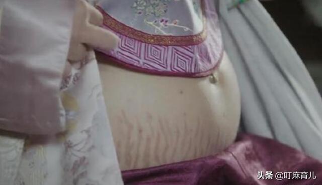 妊鉴别妊娠纹肥胖纹(妊娠纹与肥胖纹的区别图片)