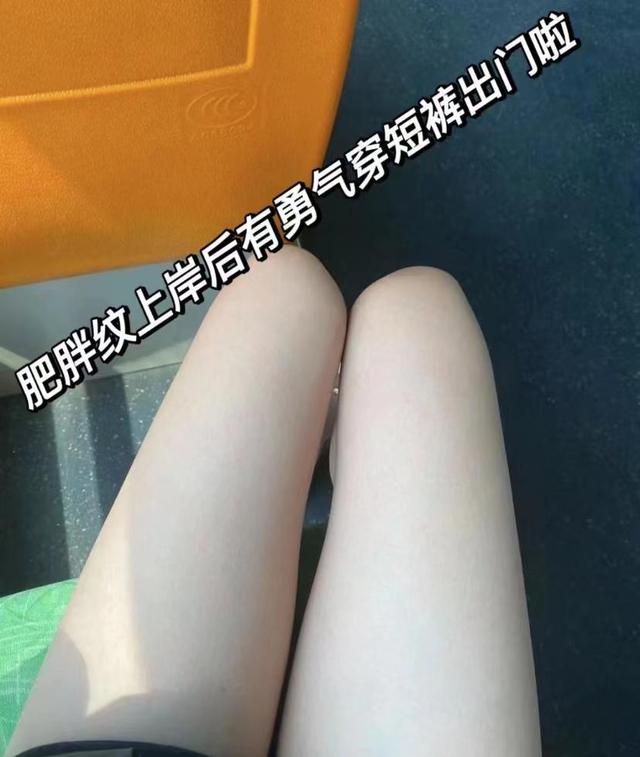 肥胖纹手法(肥胖纹治疗效果)