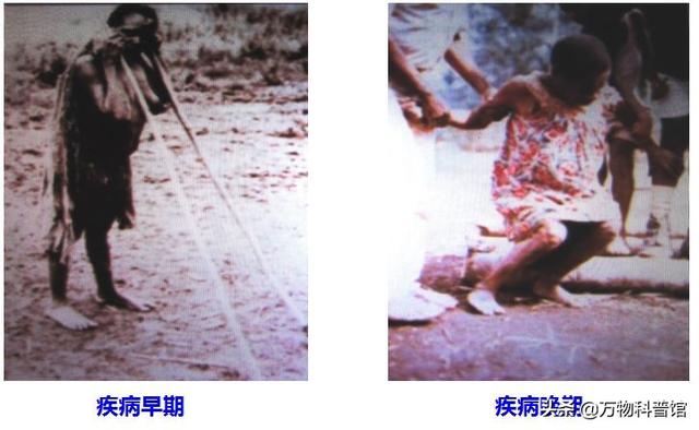 朊病毒到底是一种什么东西，千万别吃同类的肉