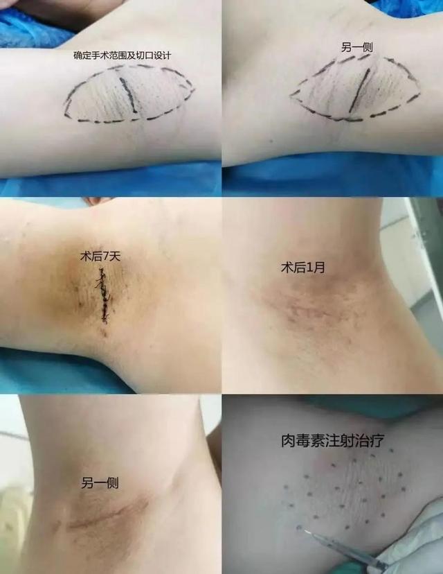 肉毒素治疗腋臭是否科学(肉毒素治疗腋臭一侧打多少)