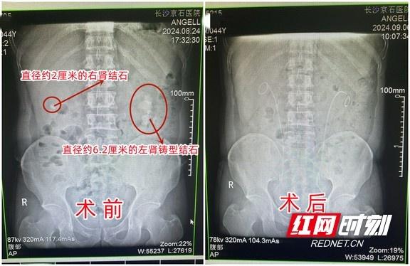 糖尿病脓肾(糖尿病肾脓肿严重吗)