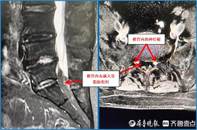 肥胖腿麻了(胖人腿麻怎么回事)