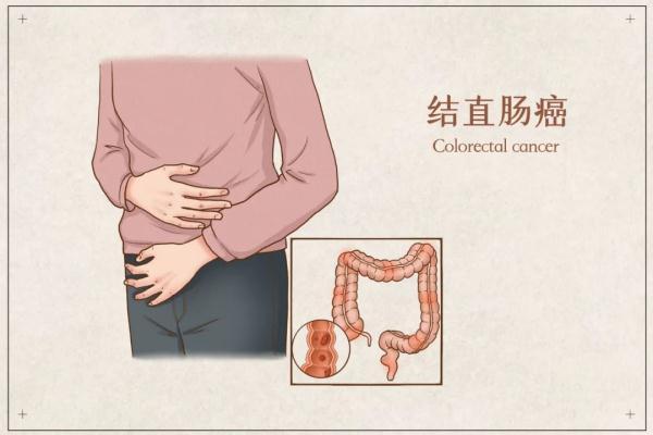 结肠癌肥胖(结肠癌肥胖在什么地方)