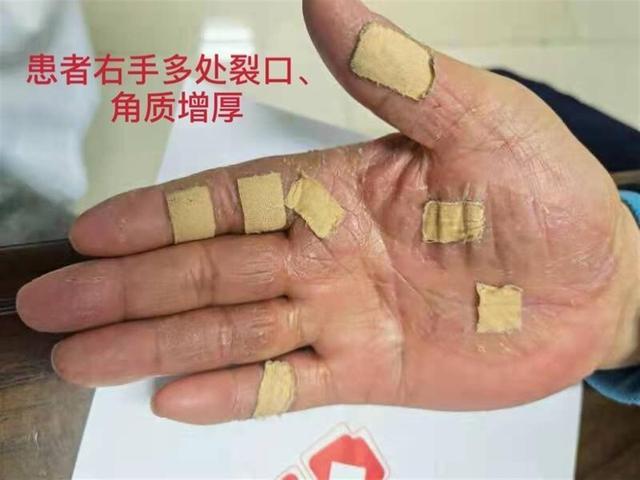糖尿病手癣(糖尿病手癣是什么原因)