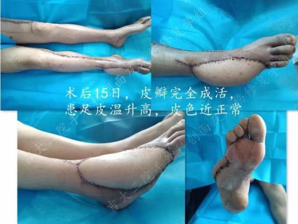 糖尿病足前沿(糖尿病足前期能治疗吗能治疗好吗)