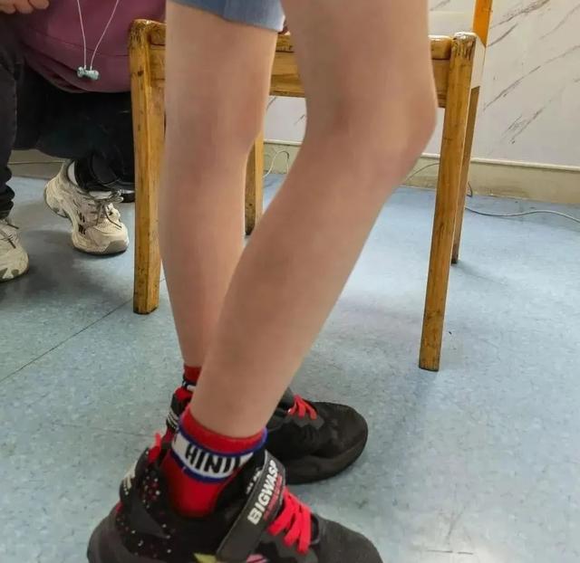 肥胖导致半月板(肥胖导致半月板损伤怎么健身减肥)