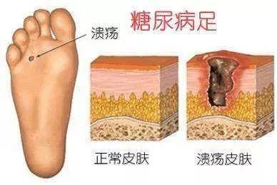 糖尿病足必须截肢吗(糖尿病足需要做手术吗)