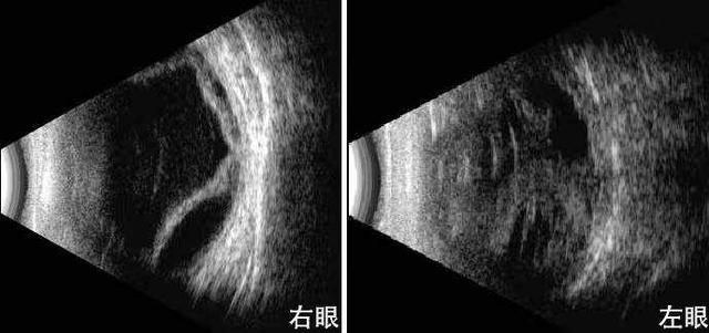 短暂性失明前兆，55岁大伯双眼先后逐渐失明