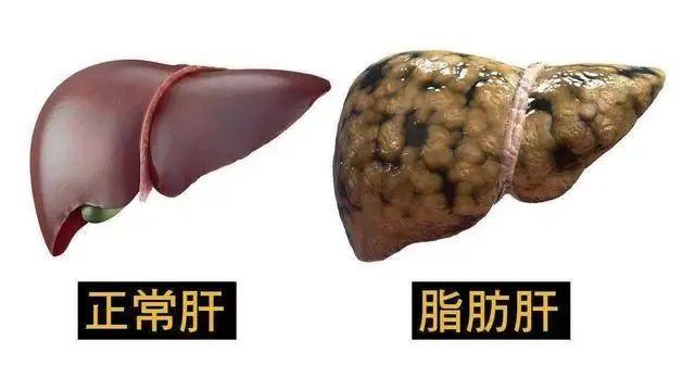 黄疸与肥胖(黄疸会导致体重增长过慢吗)