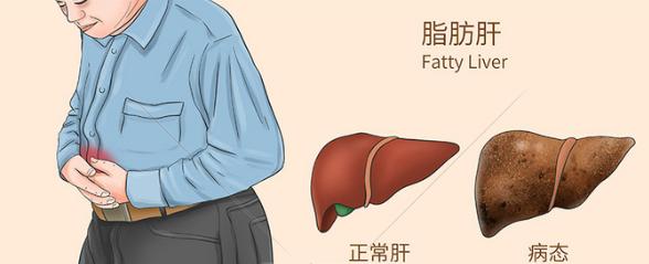 糖尿病会脾大吗(糖尿病人脾脏增大的原因)