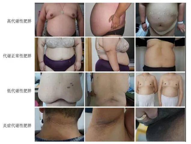 肥胖灯症状(肥胖him)