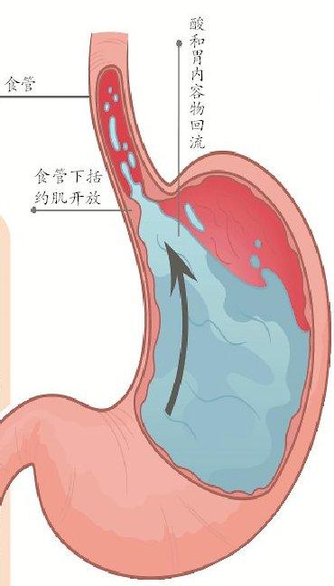 糖尿病食管炎(糖尿病会引发食道癌吗)