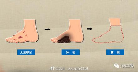 糖尿病足治愈(糖尿病足治愈后会复发吗)