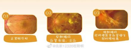 糖尿病视网膜病变2级(糖尿病视网膜病变吃什么药)