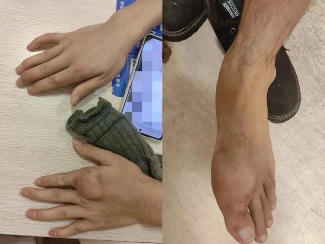 肥胖会脚痛(肥胖脚痛走都走不了)