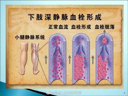 肥胖易栓症(肥胖者易患哪些疾病)