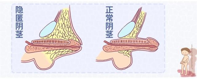 肥胖可以割包茎(肥胖者割包皮)