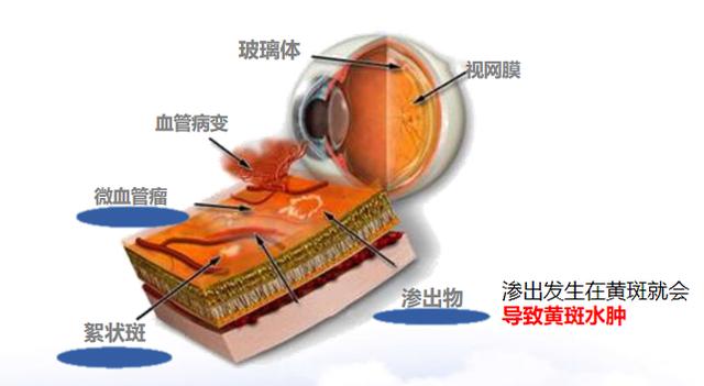 糖尿病能导致水肿吗(糖尿病导致水电解质紊乱)
