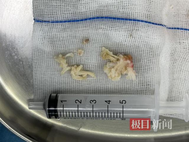 糖尿病拔罐(糖尿病拔罐子出了泡怎么处理呀)