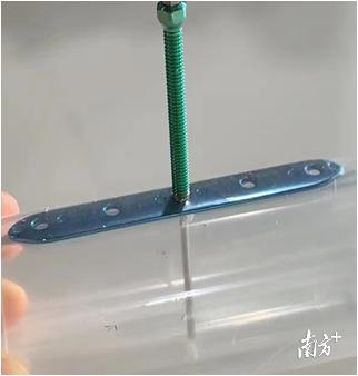糖尿病截骨(糖尿病骨头断了能愈合吗)