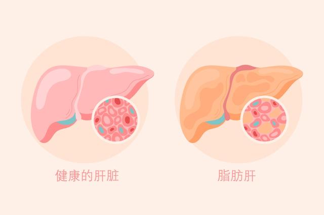 过于肥胖的人怎么减肥(肥胖的人该怎么办)
