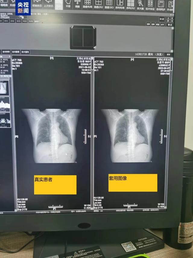 糖尿病造假(什么是假糖尿病能逆转吗)