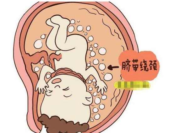 脐带绕颈一周怎么办(脐带绕颈一周怎么绕开)