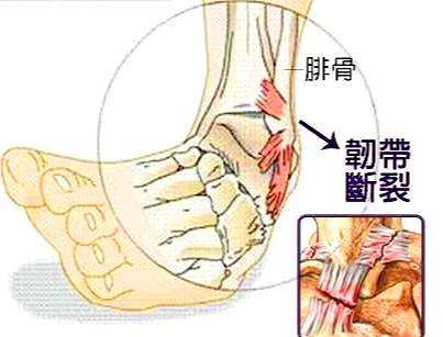 医生:韧带损伤要重视