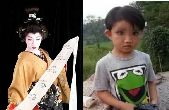 歌舞伎综合征 歌舞伎综合征女孩妮妮