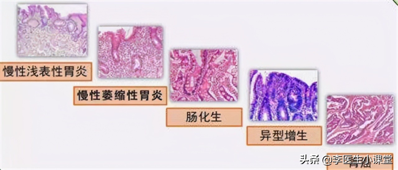 浅表性胃炎的症状 浅表性胃炎常备药